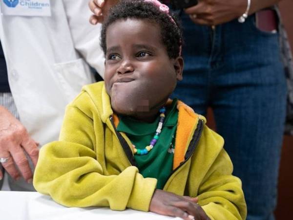 Keadaan muka Nagelam Alafa selepas dia dibedah pada 23 Jun lalu. - Foto Barry Williams/ New York Daily News