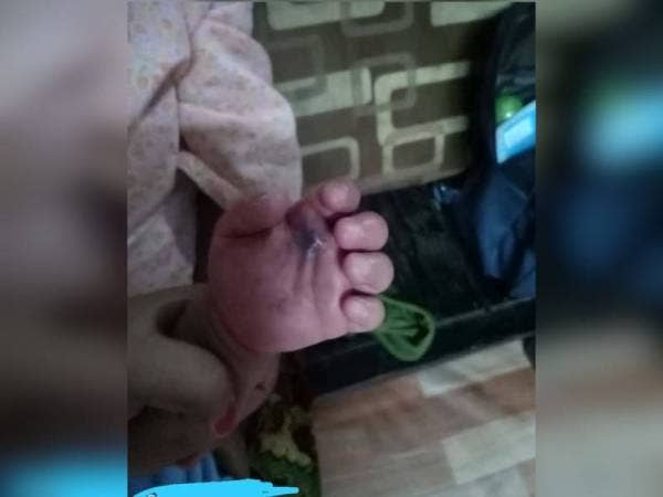 Terdapat kesan patukan ular pada tangan mangsa. - Foto Ihsan media sosial