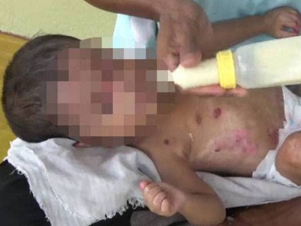 Penyakit 'epidermolysis bullosa' yang ditanggung Muhammad Qawiy Mohamad Abdullah turut menyebabkan pergerakan terbatas. - Foto Astro Awani