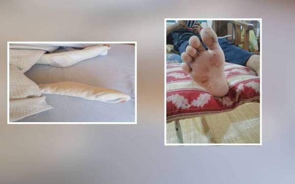 Kedua-dua belah kaki Luzman dibalut selepas selesai proses mencabut kesemua duri landak laut di HSNZ.Foto Ihsan keluarga