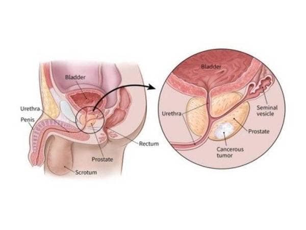 Infografik mengenai kanser prostat.