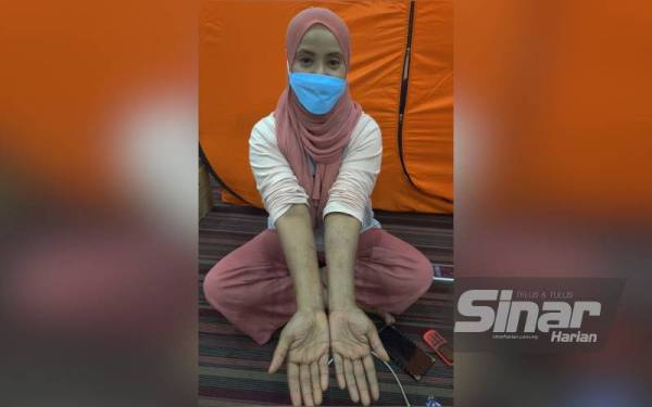 Siti Subaidah menunjukkan kedua-dua tangannya mengalami alahan teruk akibat banjir.
