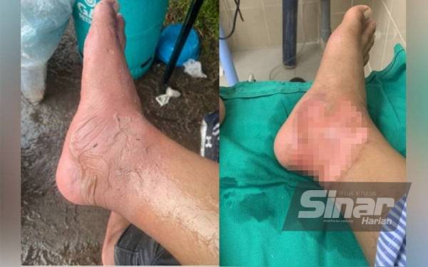 Keadaan kaki Zaquan yang melecur akibat tersimbah minyak panas dalam kejadian ribut di Bandar Meru Raya pada Isnin.