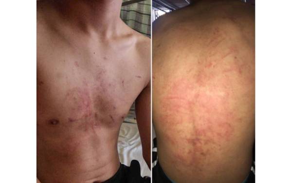 Mangsa mengalami kecederaan didakwa dipukul pelajar senior pada Sabtu lalu.