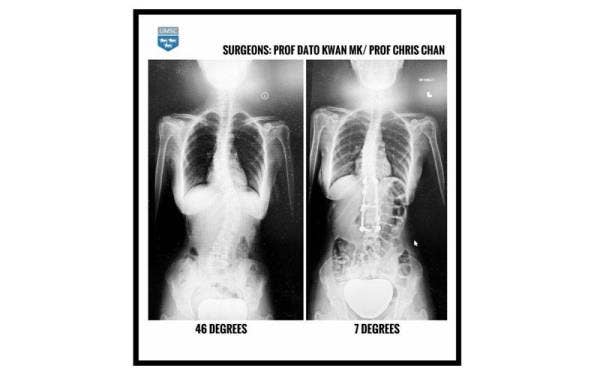 X-ray menunjukkan sebelum dan selepas pembedahan.