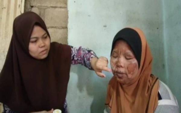 Kakak Maziha, Mastura Abdullah (kiri) membantu menyapu ubat di muka Maziha di kediamannya di sini.