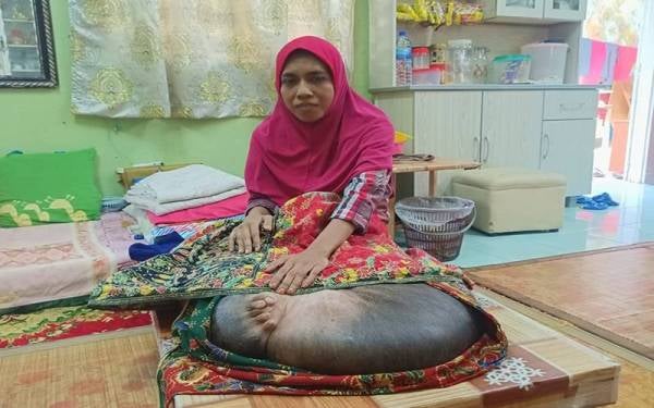 Sinar Harian pada 29 Januari lalu melaporkan, bengkak mengejut pada kaki kanan mengubah hidup Rosmiza dari Kampung Kubang Bunut, Kasar yang kini menderita penyakit kaki gajah sejak 28 tahun lalu.