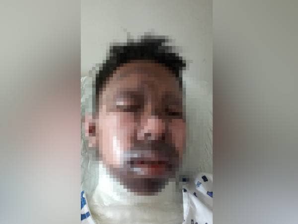 Keadaan Muhammad Hafiz yang mendapat rawatan di HSB Alor Setar selepas cedera dan melecur akibat terkena percikan meriam karbaid pada 13 April lalu.