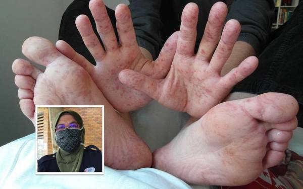 Kes HFMD di Pahang meningkat enam kali ganda iaitu 1,145 kes sehingga 7 Mei lalu. Gambar kecil: Dr Nor Azimi