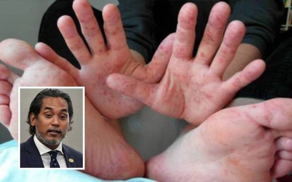 Kes HFMD terus mencatatkan peningkatan dengan 28,957 kes di seluruh negara pada Minggu Epid 19 sejak Januari hingga Jumaat. (Gambar kecil: Khairy Jamaluddin Abu Bakar)