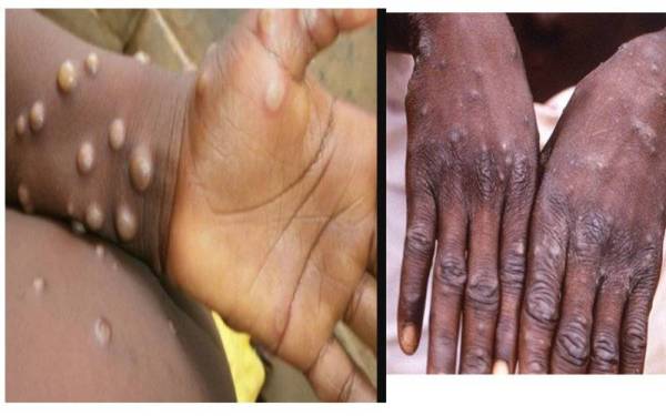  Pihak berkuasa di Amerika Utara dan Eropah telah mengesan puluhan kes disyaki atau disahkan monkeypox atau cacar monyet sejak awal Mei yang sekali gus mencetuskan kebimbangan penyakit endemik di bahagian Afrika sedang menular cepat. Foto: Sumber internet.