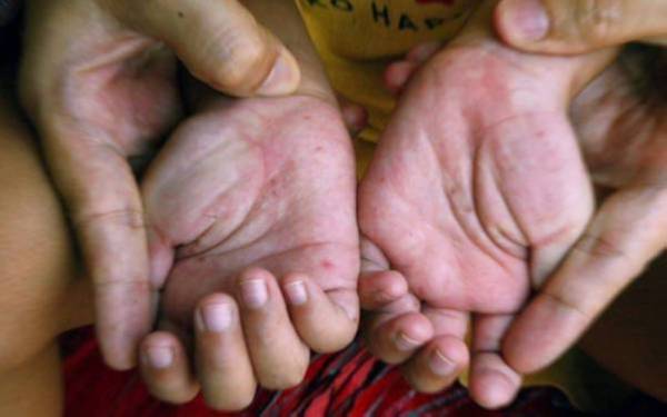 Peningkatan kes HFMD yang ketara pada tahun ini berbanding tahun lepas berikutan pembukaan semula sektor pendidikan dan tempat awam.