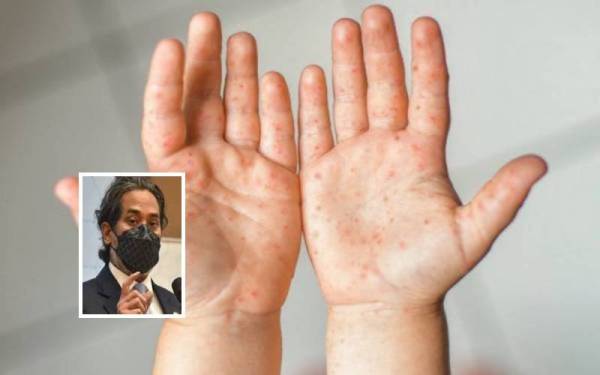 (Gambar kecil: Khairy Jamaluddin) Dua kanak-kanak yang disahkan dijangkiti penyakit tangan, kaki dan mulut (HFMD) dilaporkan mengalami gejala teruk dan memerlukan rawatan di unit rawatan rapi (ICU).- Gambar hiasan