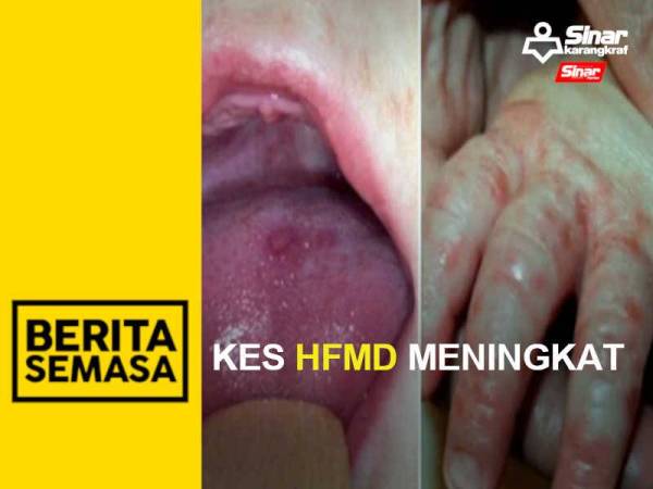 BS PORTAL - HFMD