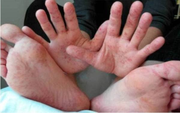  Sebanyak 1,174 kes HFMD dilaporkan di Perlis sejak awal Januari hingga Jumaat. - Gambar hiasan