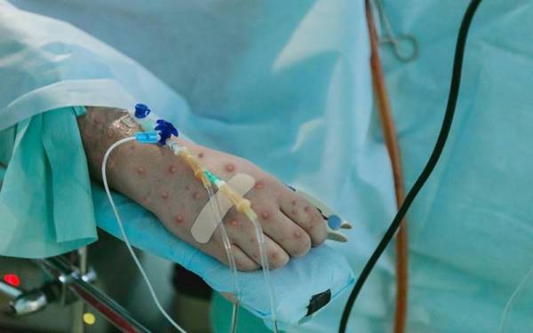 Lebih daripada 700 kes cacar monyet dilaporkan di seluruh dunia sehingga Jumaat. (Gambar hiasan) - Foto 123RF