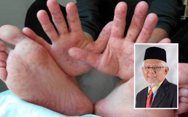 Lima wabak baharu dilaporkan melibatkan taska dan tadika. (Gambar kecil: Dr Mohd Hayati)