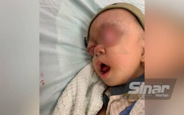 Lebih membimbangkan masalah utama Muhammad Hafiy adalah apabila menangis, akan berlaku tekanan kuat pada kepalanya dan ia menyebabkan matanya keluar daripada soket.