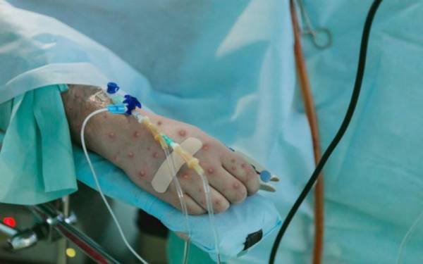 Eropah mencatatkan korban pertama akibat penyakit cacar monyet selepas Sepanyol pada Jumaat mengesahkan satu kes kematian disebabkan wabak itu. - Gambar hiasan