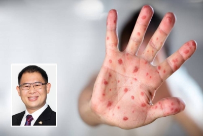 Sebanyak 8,720 kes HFMD dilaporkan setakat Sabtu. (Gambar kecil: Tian Soon)