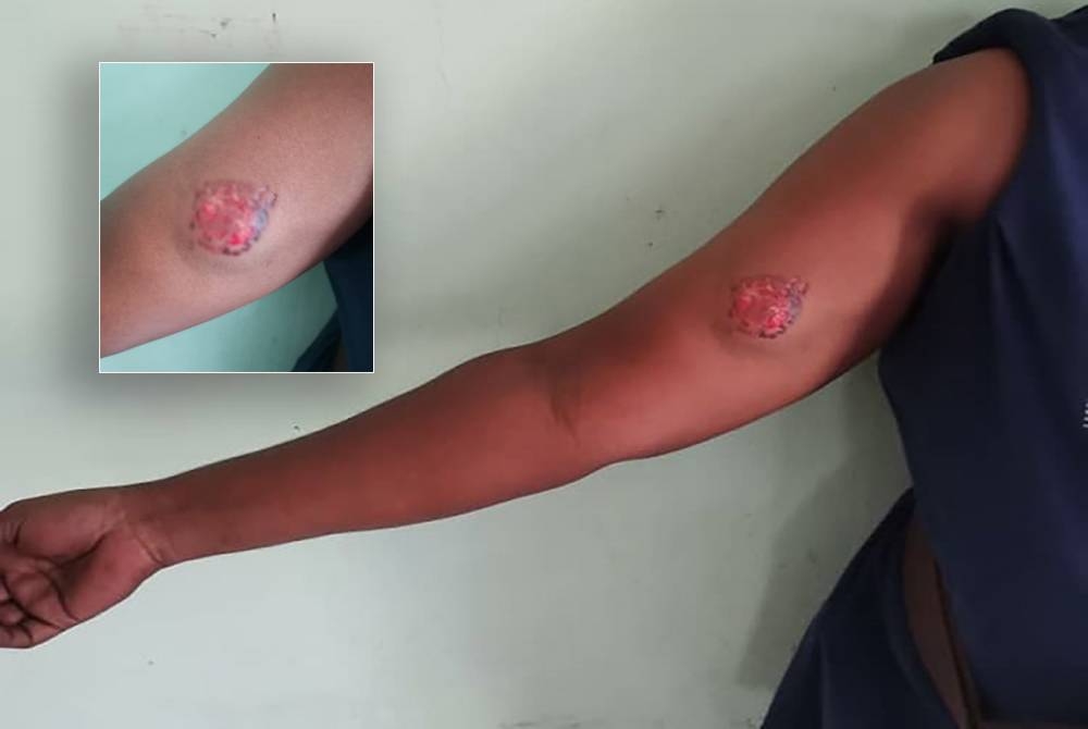 Seorang anggota polis cedera di bahagian lengan selepas digigit seorang lelaki yang membuat kacau di sebuah stesen minyak di Bukit Gambir, Tangkak pada Rabu. (Gambar kecil: Kesan kecederaan yang dialami anggota polis terbabit)