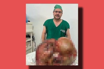 Sepasukan doktor berjaya mengeluarkan 'tumor gergasi' seberat 45kg ketika pembedahan kecemasan di sebuah hospital di Brazil pada Rabu lalu.