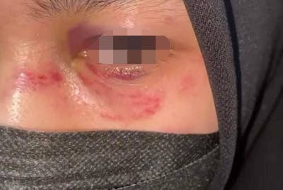 Gambar kecederaan yang dialami mangsa pada Ogos lalu tular di media sosial baru-baru ini. - Foto ihsan pembaca