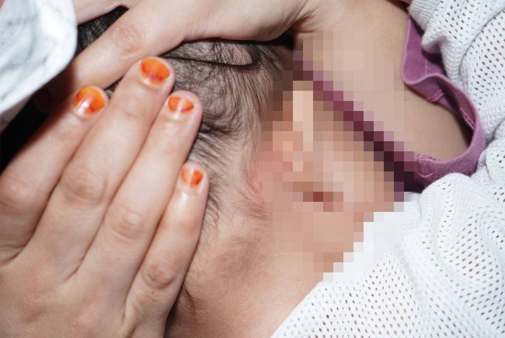 Mangsa mengalami kecederaan dengan kesan gigitan pada muka dan kesan pulasan pada kedua-dua telinganya.