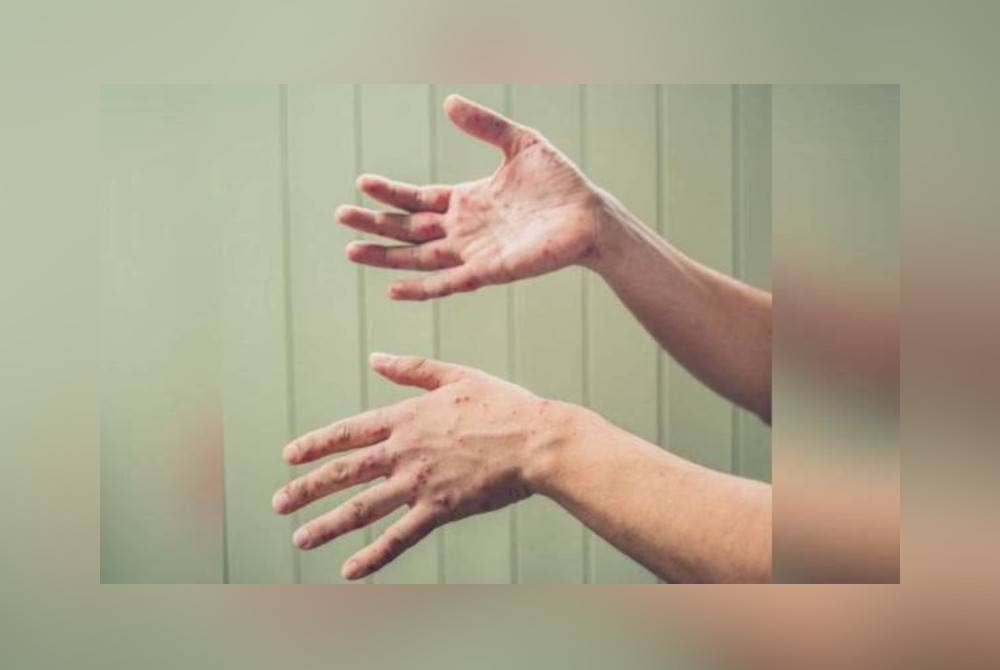 Seorang lelaki tempatan berusia 40 tahun yang pulang dari Qatar disahkan positif kes cacar monyet, kes ke-11 yang dilaporkan di Thailand. - Foto 123RF