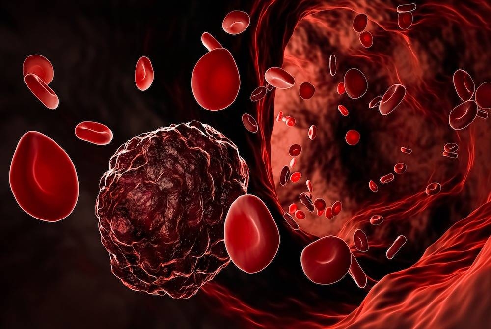 Sel kanker atau tumor kanker di tengah sel darah merah yang mengalir dalam pembuluh darah, arteri atau vena memberikan ilustrasi 3D.