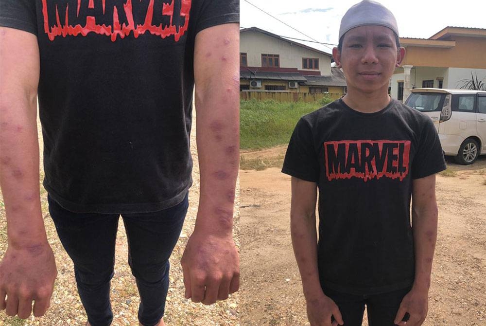 L'état de la peau du bras de Tuan Mohamad Hanif qui est cicatrisé et n'est plus boursouflé.  Tuan Mohamad Hanif (photo de droite) est maintenant positif après que son état de peau se soit amélioré.