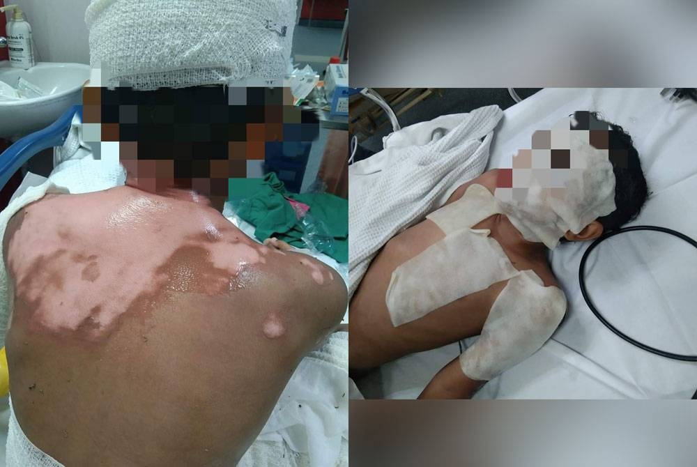 Dua kanak-kanak melecur selepas dipercayai terkena letupan asid serbuk soda dalam kejadian di sebuah pangsapuri di Seri Kembangan, pada Selasa. - Foto: Facebook