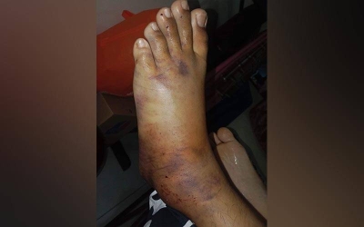 HTJ akan tubuhkan jawatankuasa bagi menyiasat dakwaan berlaku kecuaian terhadap seorang kanak-kanak yang dapatkan rawatan di hospital terbabit pada 3 Februari lalu berikutan kakinya digilis bas. - Foto Facebook