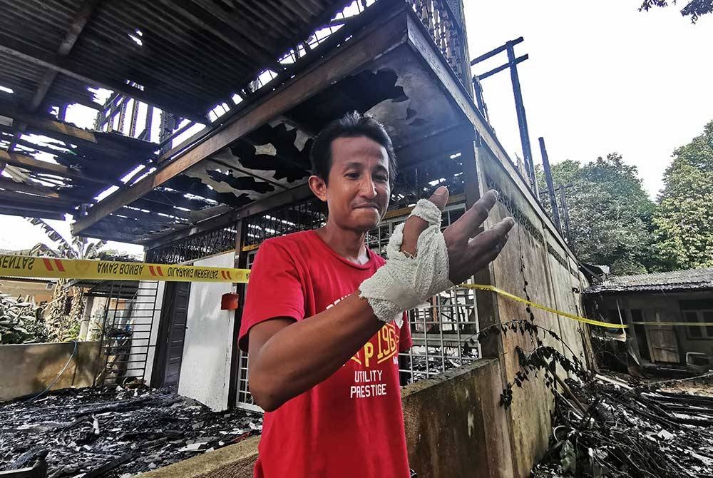Jazli menunjukkan keadaan tangannya yang melecur akibat terkena api dalam kebakaran rumah di Kampung Pak Madah, Bukit Payong, Marang pada malam Selasa.