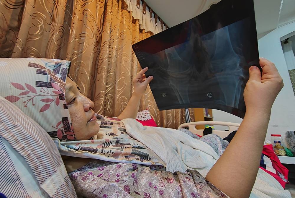 A'fiyah menunjukkan imbasan x-ray keadaan tempurung lututnya.