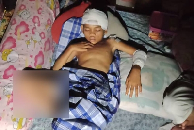 Kecederaan yang dialami kanak-kanak berusia sembilan tahun selepas dibaham buaya ketika berenang di kawasan perumahan atas air di Kampung Batu Putih, Sandakan.