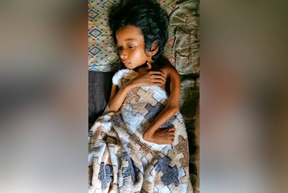 Muhammad Hafizuddin menderita penyakit saraf sehingga pembesarannya terbantut dan hanya seberat 10 kilogram.