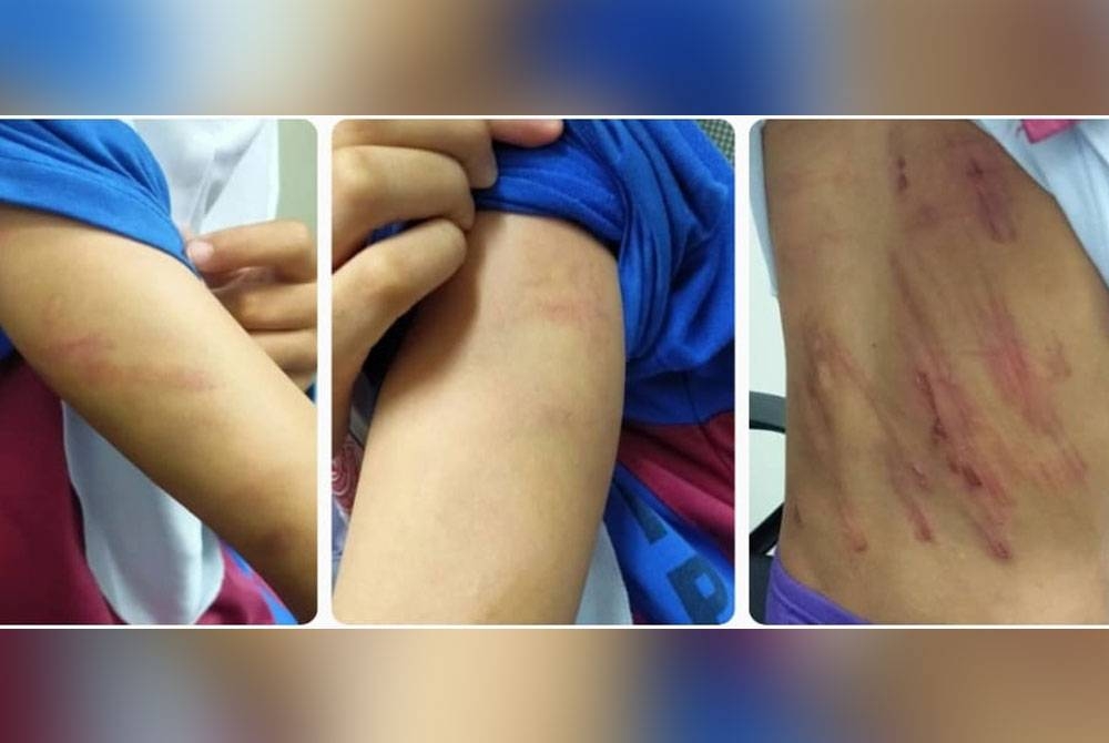 Antara kesan kecederaan yang terdapat pada badan mangsa dipercayai dipukul ibu tirinya dalam kejadian pada Sabtu lalu. - Foto: PDRM