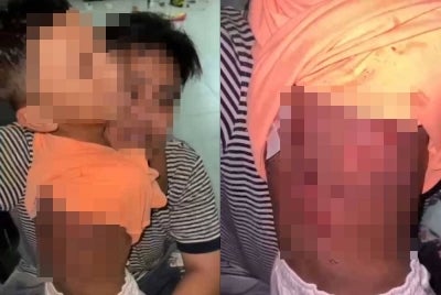 Kecederaan di bahagian belakang badan kanak-kanak lelaki dipercayai akibat kesan dera. - Foto Layangkasa