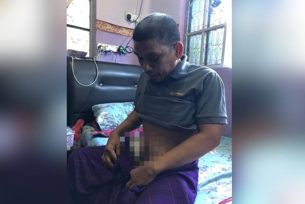 Mohamad Idris perlu memakai beg stoma selepas menjalani pembedahan bagi merawat kanser usus yang dihidapnya pada Januari lalu.