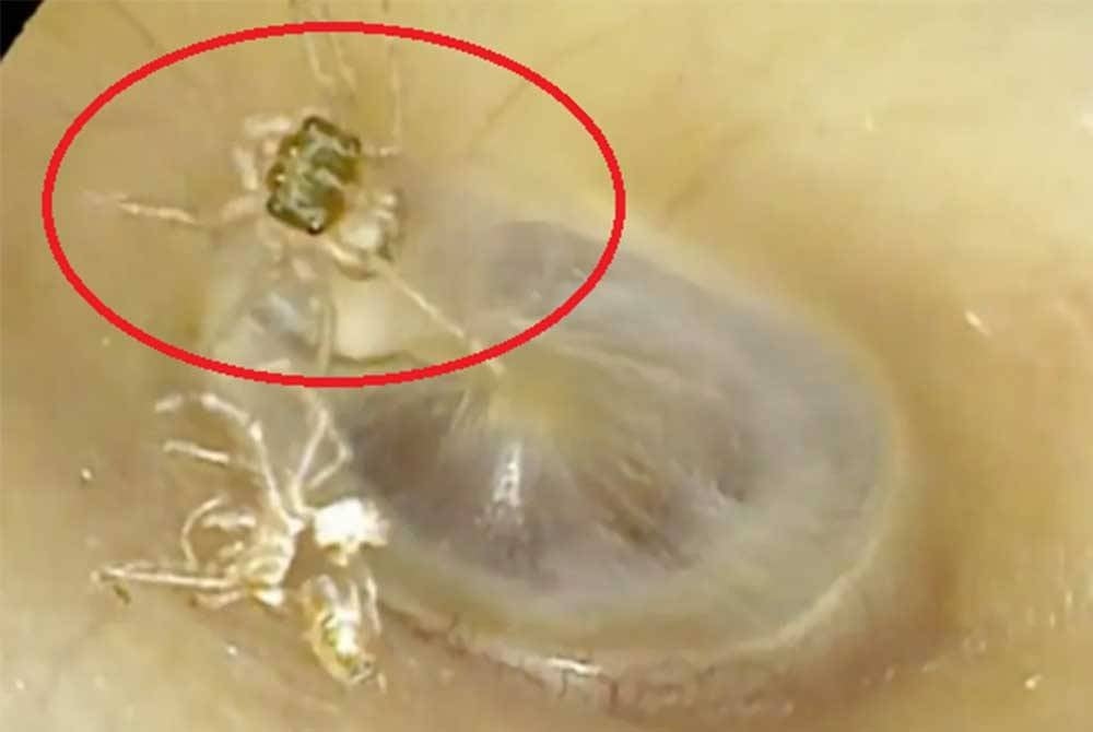 Labah-labah yang ditemui dalam telinga seorang warga emas di Taiwan. - Agensi