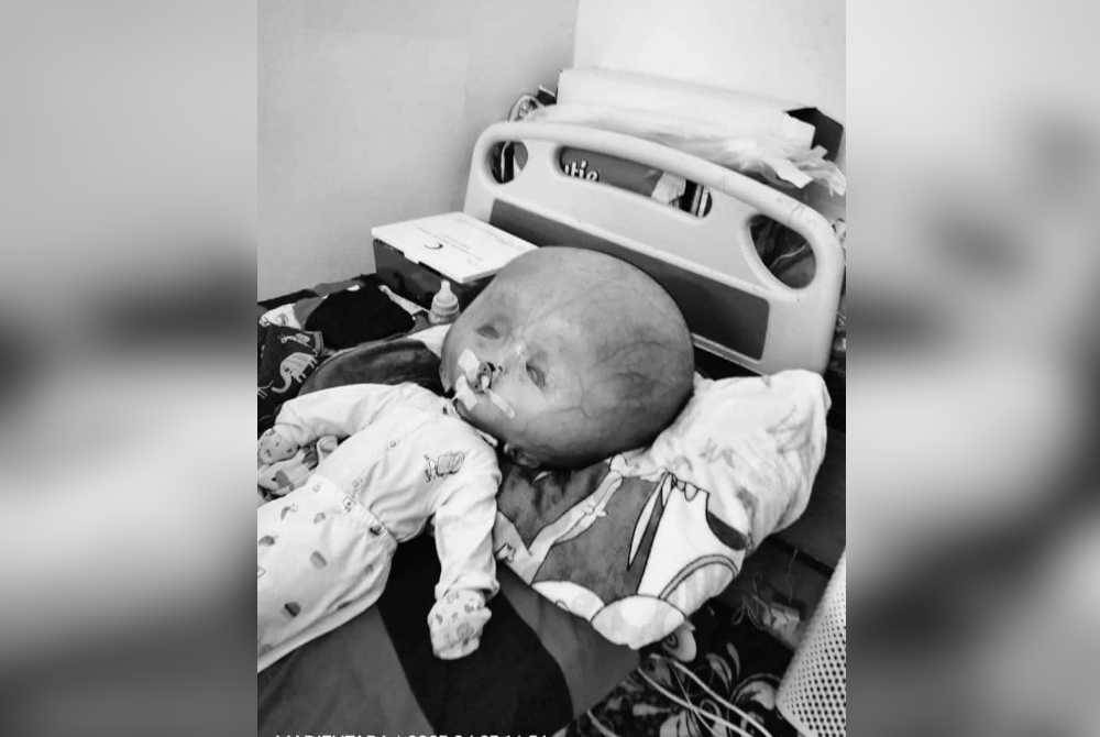 Anak syurga yang menderita penyakit kepala besar selain sumbing di bibir dan hidung, Muhammad Bilal Yusra, 3, dilaporkan meninggal dunia jam 4.50 pagi Jumaat. - Gambar media sosial.