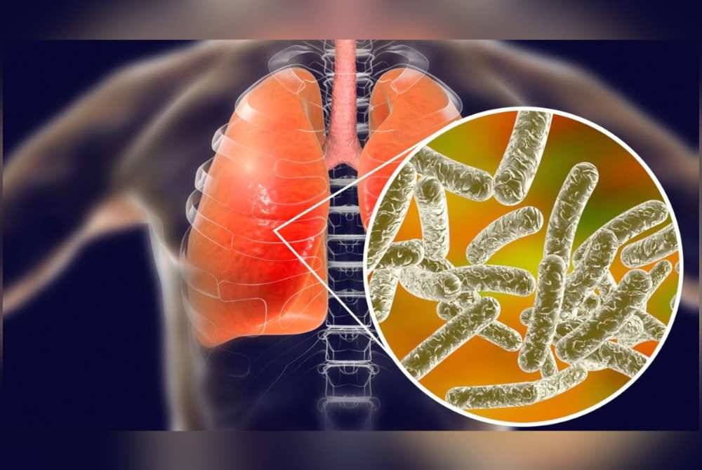 Kesemua pesakit kini menerima rawatan radang paru-paru dan disahkan dijangkiti bakteria Legionella yang menyebabkan penyakit Legionnaires.