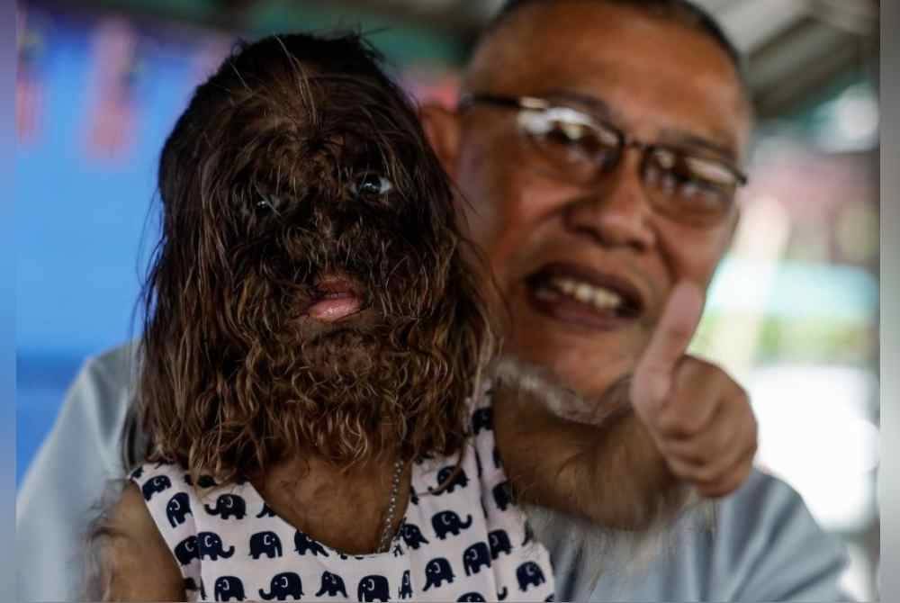 Missclyen, 2, dikenal pasti menghidap sindrom Congenital Generalised Hypertrichosis. - Foto Bernama