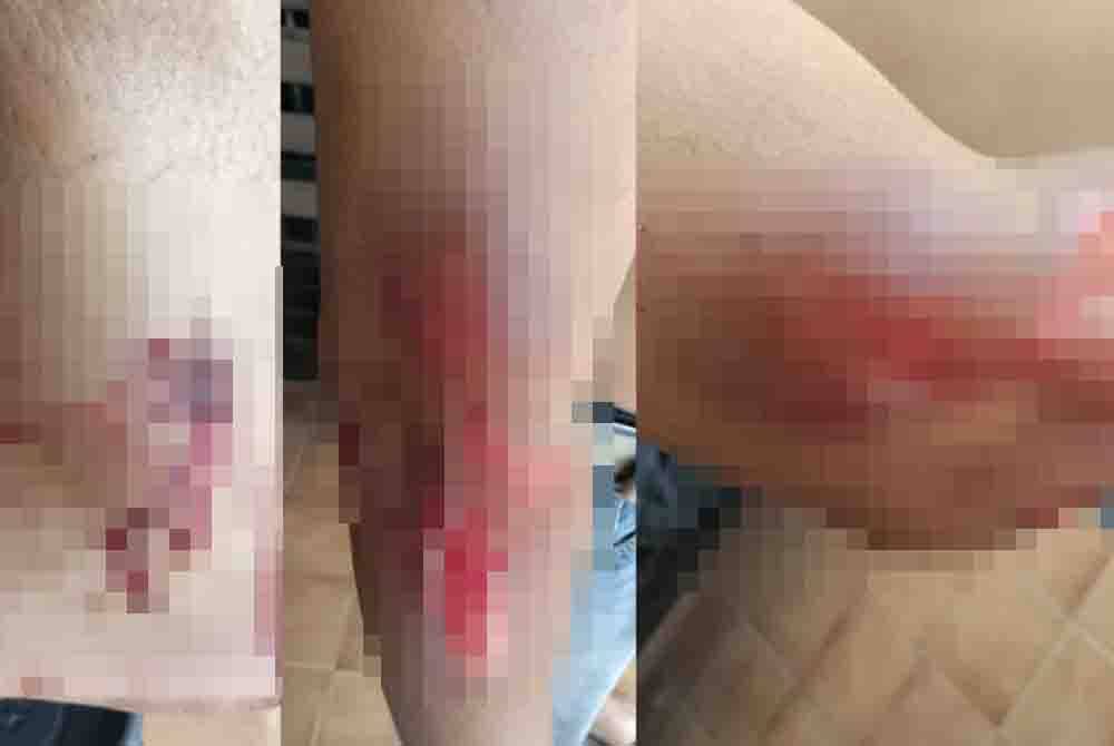 Mangsa cedera akibat diseret ketika cuba 'menyelamatkan' kereta miliknya yang dilarikan penjenayah. Foto ihsan PDRM