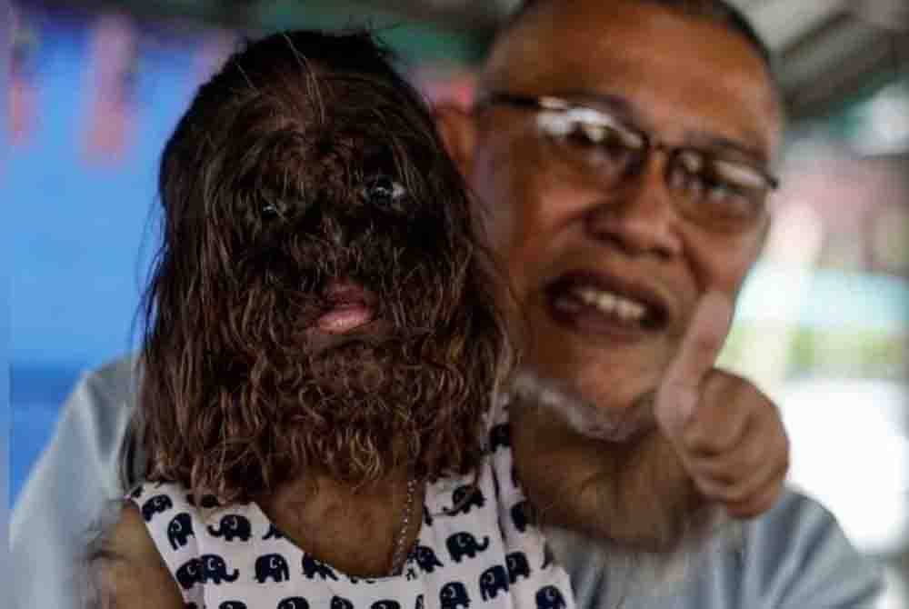 Missclyen, 2, dikenal pasti menghidap sindrom Congenital Generalised Hypertrichosis. - Foto Bernama