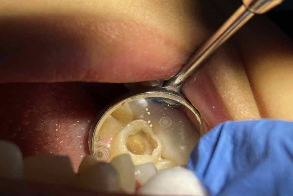 Keadaan gigi seorang kanak-kanak jalanan yang mendapatkan perkhidmatan rawatan pergigian percuma. Foto Bernama