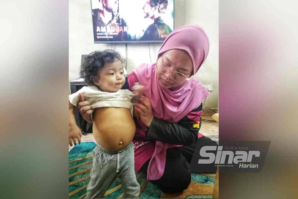 Keadaan perut Khayla akibat kegagalan fungsi hati.