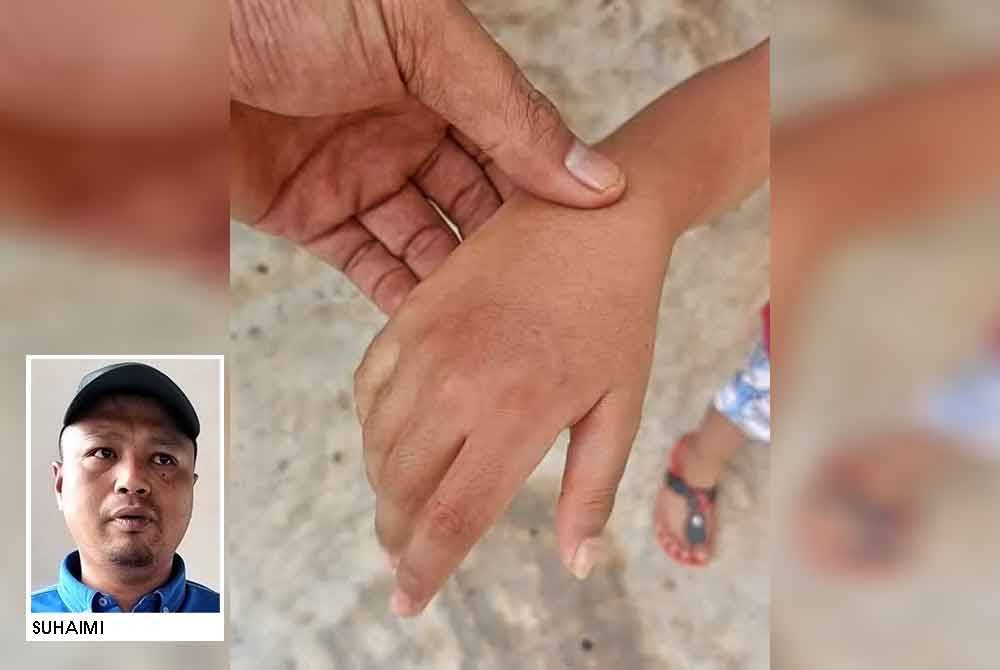 Suhaimi menunjukkan keadaan luka di tangan anaknya semakin pulih selepas diserang anjing pada Selasa lalu.