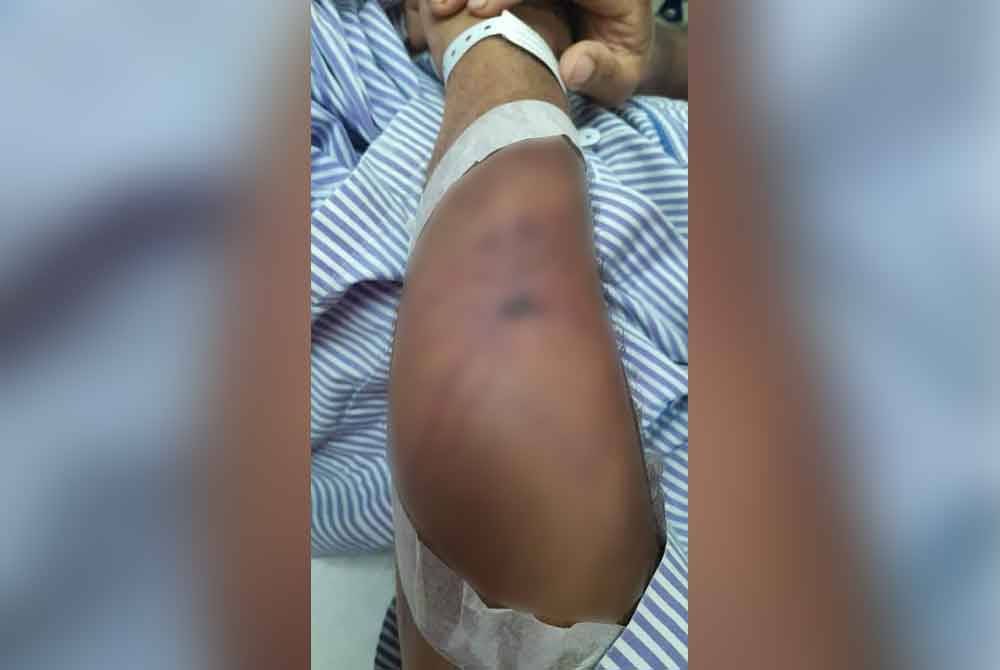 Antara kecederaan yang dihadapi mangsa.